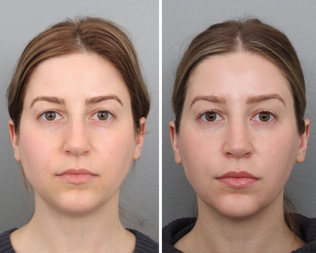 Rhinoplasty Before & After Gallery - Patient 120285471 - Image 3