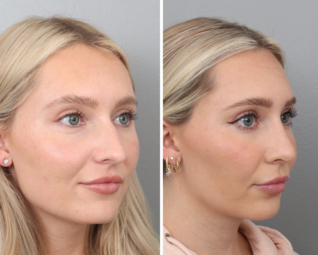 Rhinoplasty Before & After Gallery - Patient 120285487 - Image 2