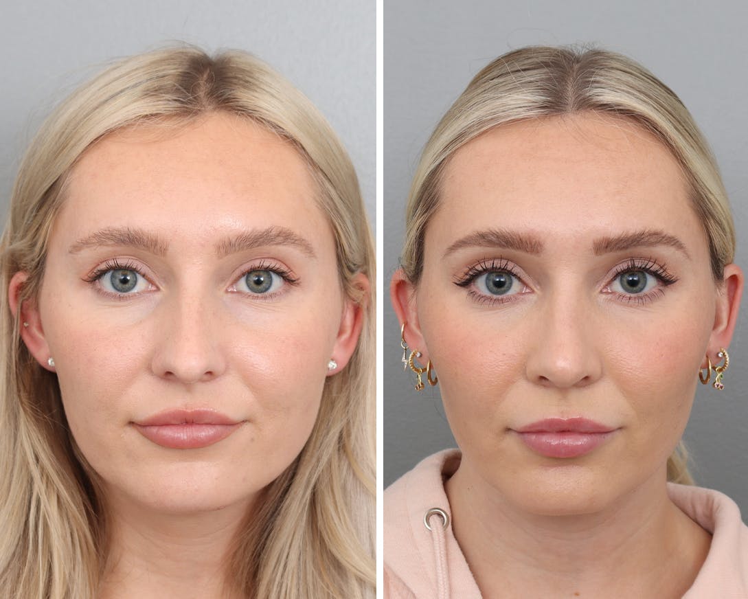 Rhinoplasty Before & After Gallery - Patient 120285487 - Image 3