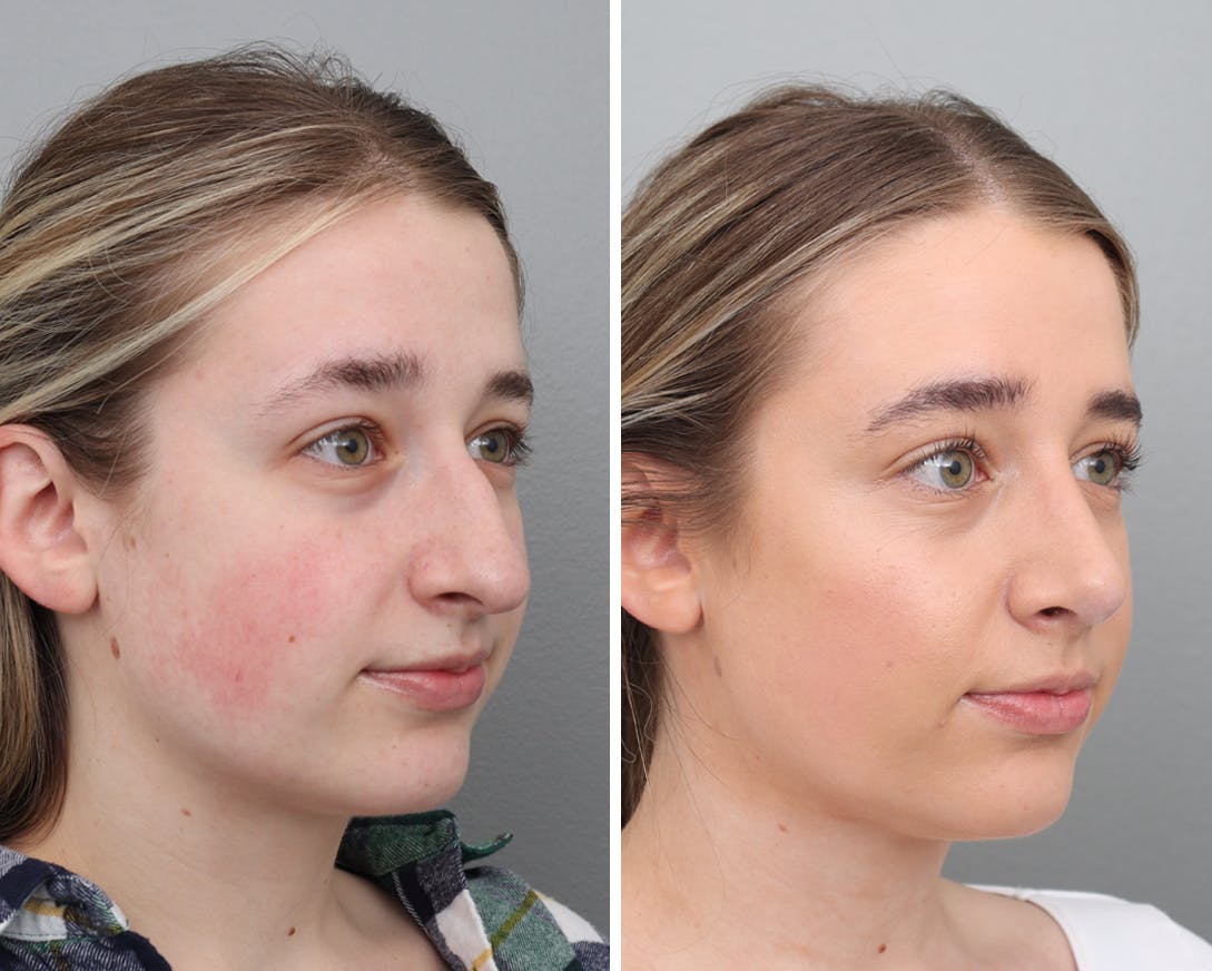 Rhinoplasty Before & After Gallery - Patient 120327318 - Image 1