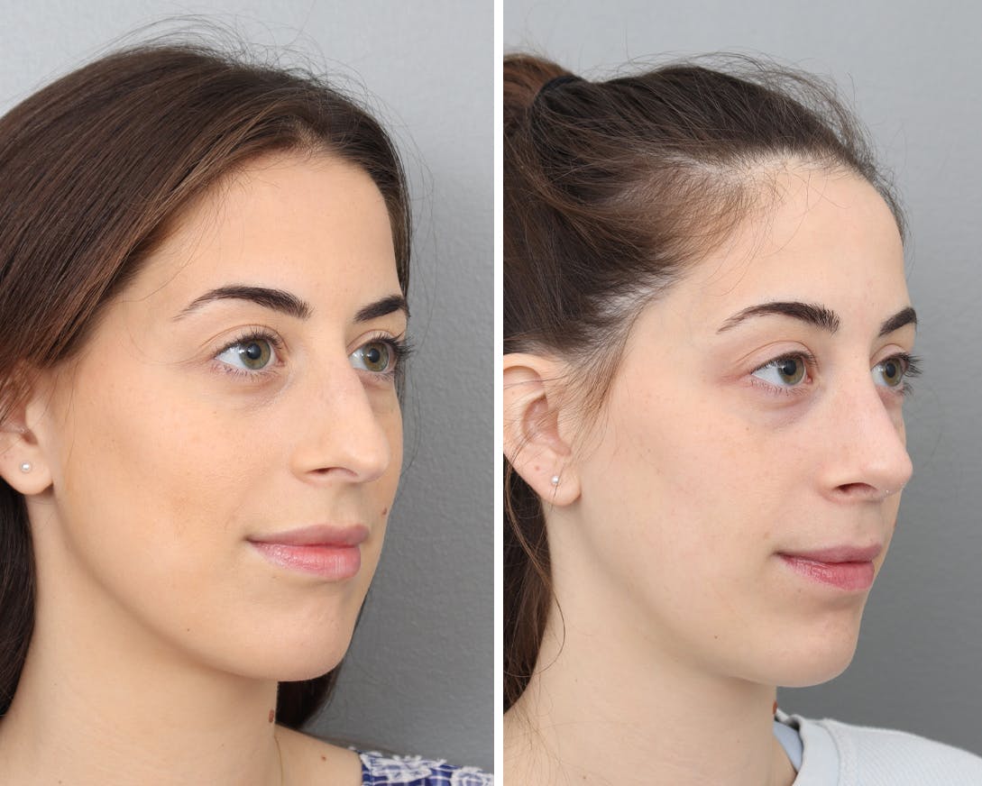 Rhinoplasty Before & After Gallery - Patient 120327333 - Image 1