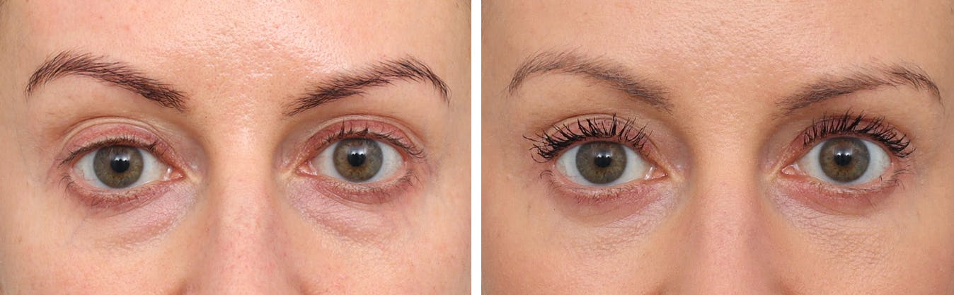 Blepharoplasty Before & After Gallery - Patient 129656176 - Image 1