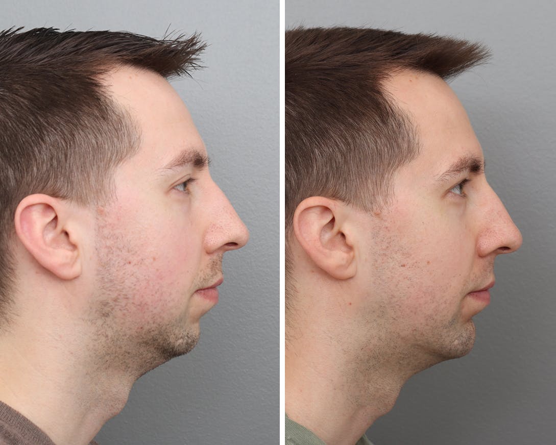 Chin Augmentation Before & After Gallery - Patient 176820162 - Image 1