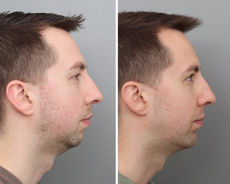 Chin Augmentation Before & After Gallery - Patient 176820162 - Image 1