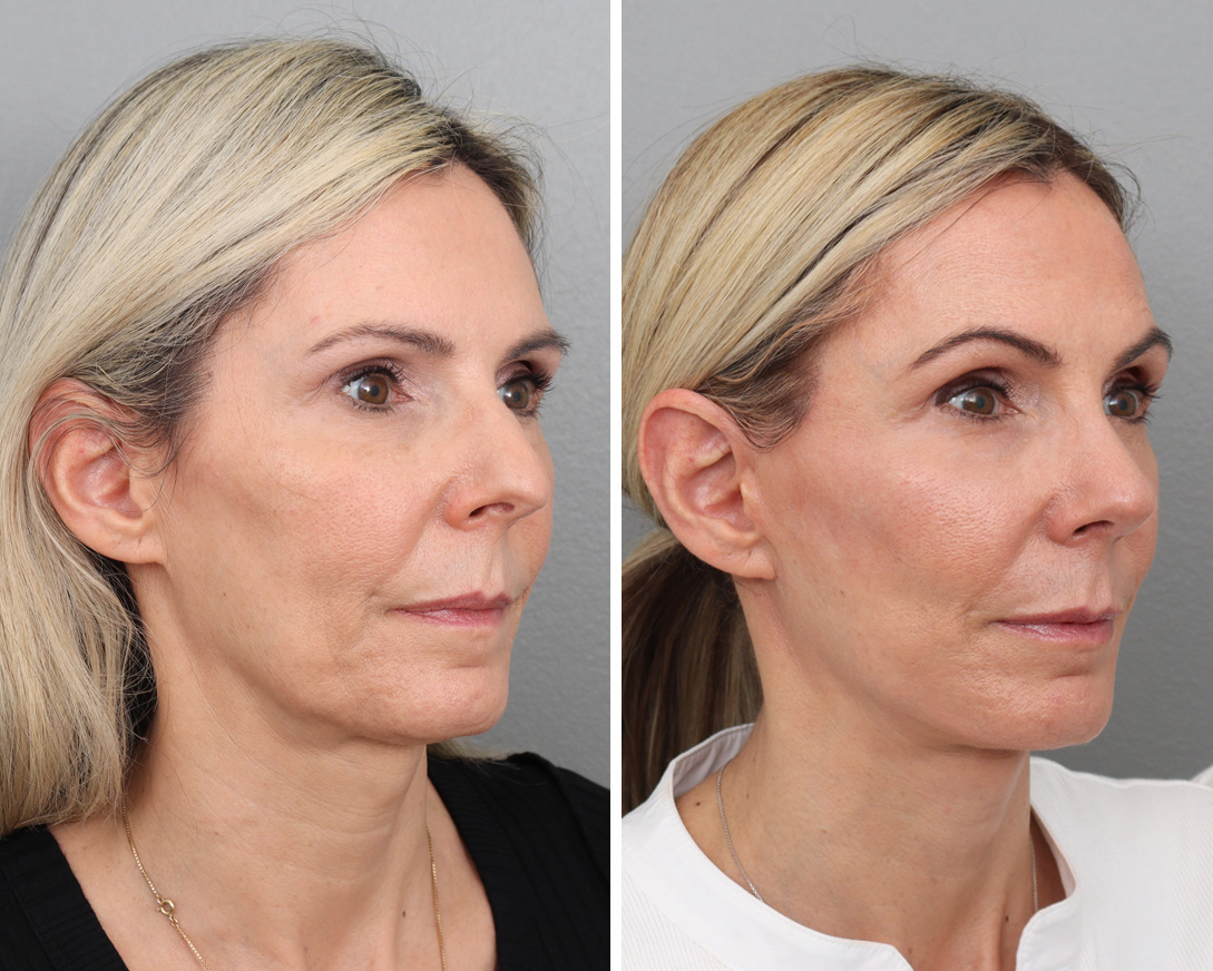 Patient 176816880 Facelift Before & After Photos Gold Coast Plastic