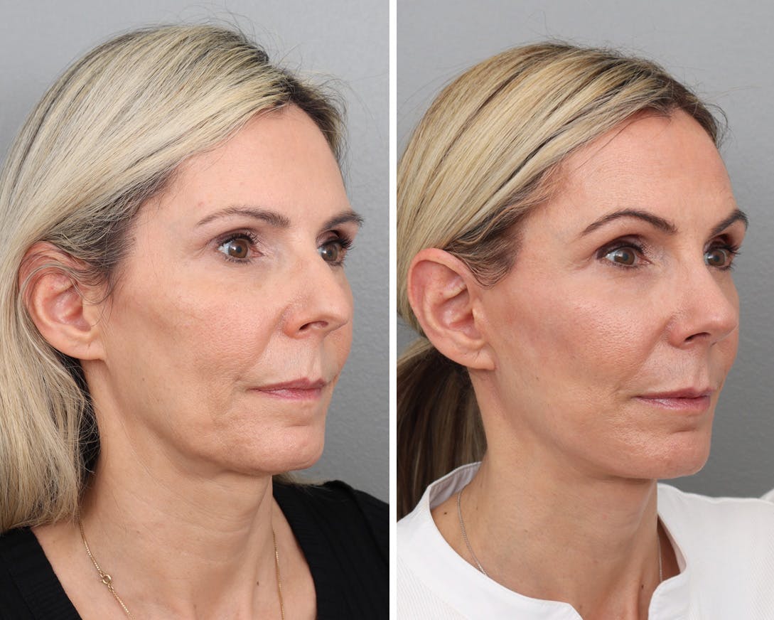 Facelift Before & After Gallery - Patient 176816880 - Image 2
