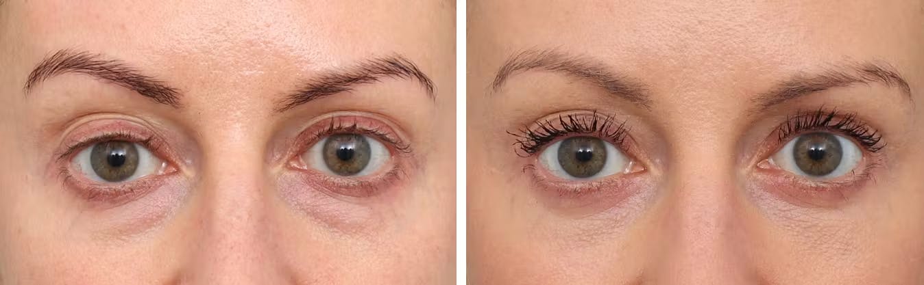 Blepharoplasty Before & After Gallery - Patient 182101051 - Image 1
