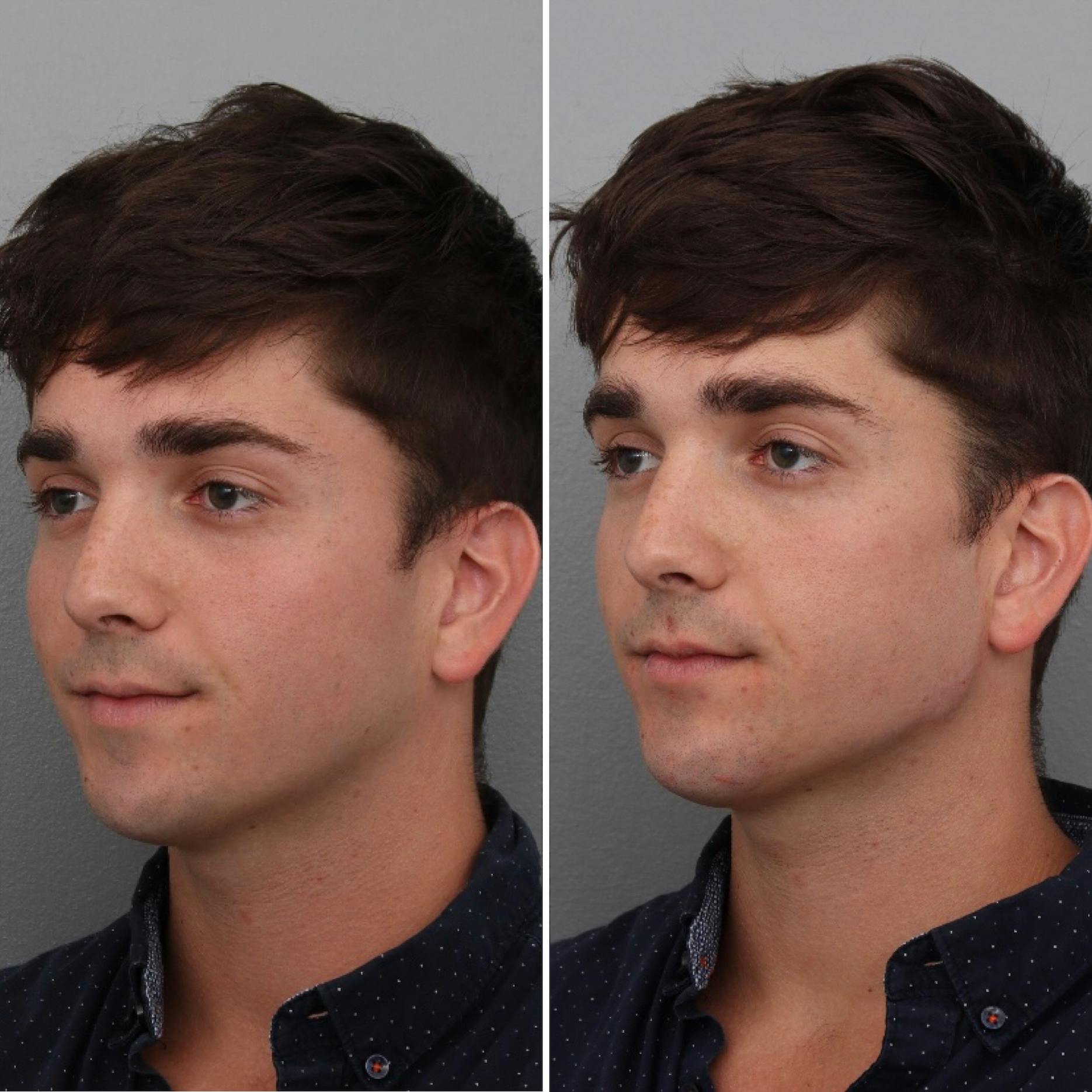 Jawline/Chin Before & After Gallery - Patient 182101180 - Image 1