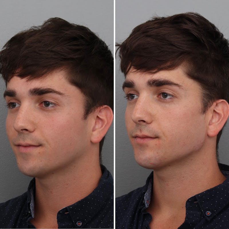 Jawline/Chin Before & After Gallery - Patient 182101180 - Image 1