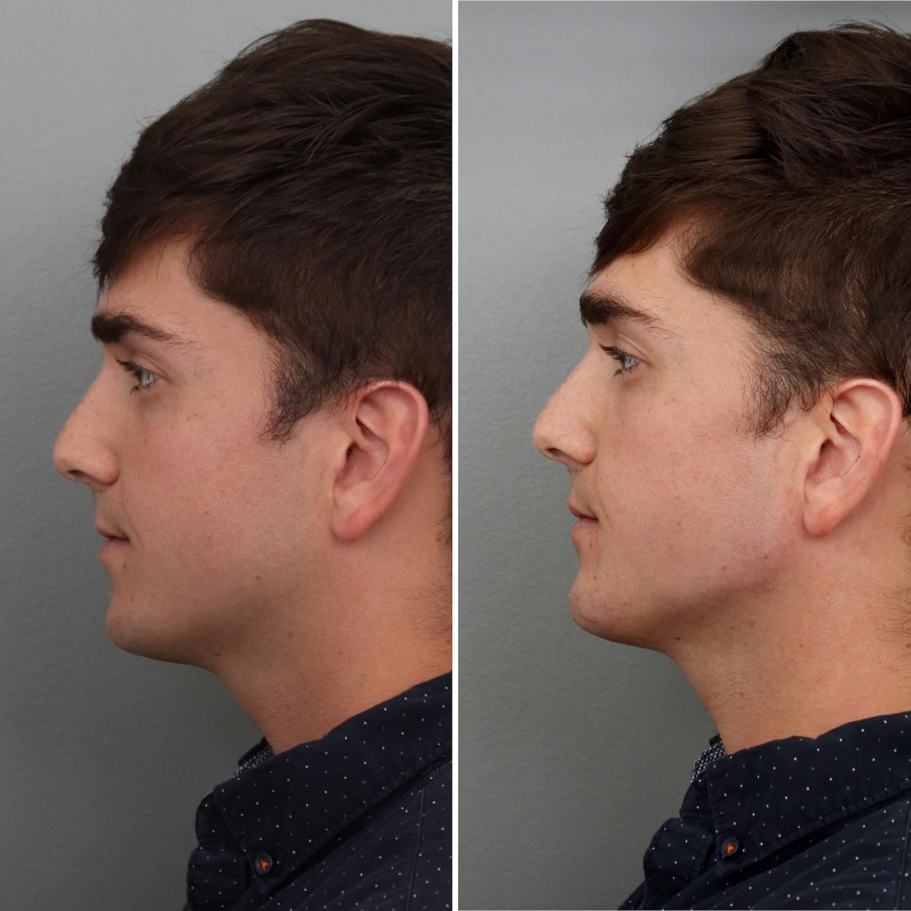 Jawline/Chin Before & After Gallery - Patient 182101180 - Image 2