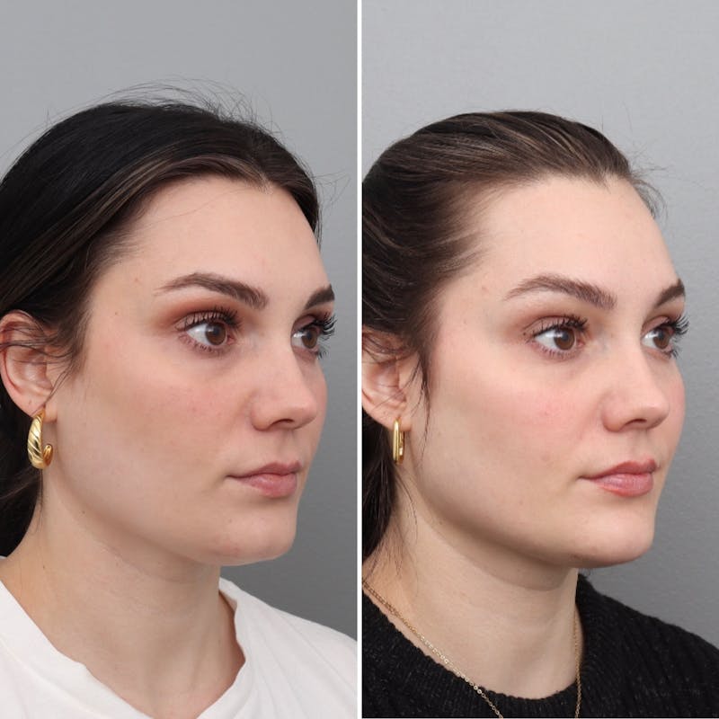 Jawline/Chin Before & After Gallery - Patient 182101181 - Image 1