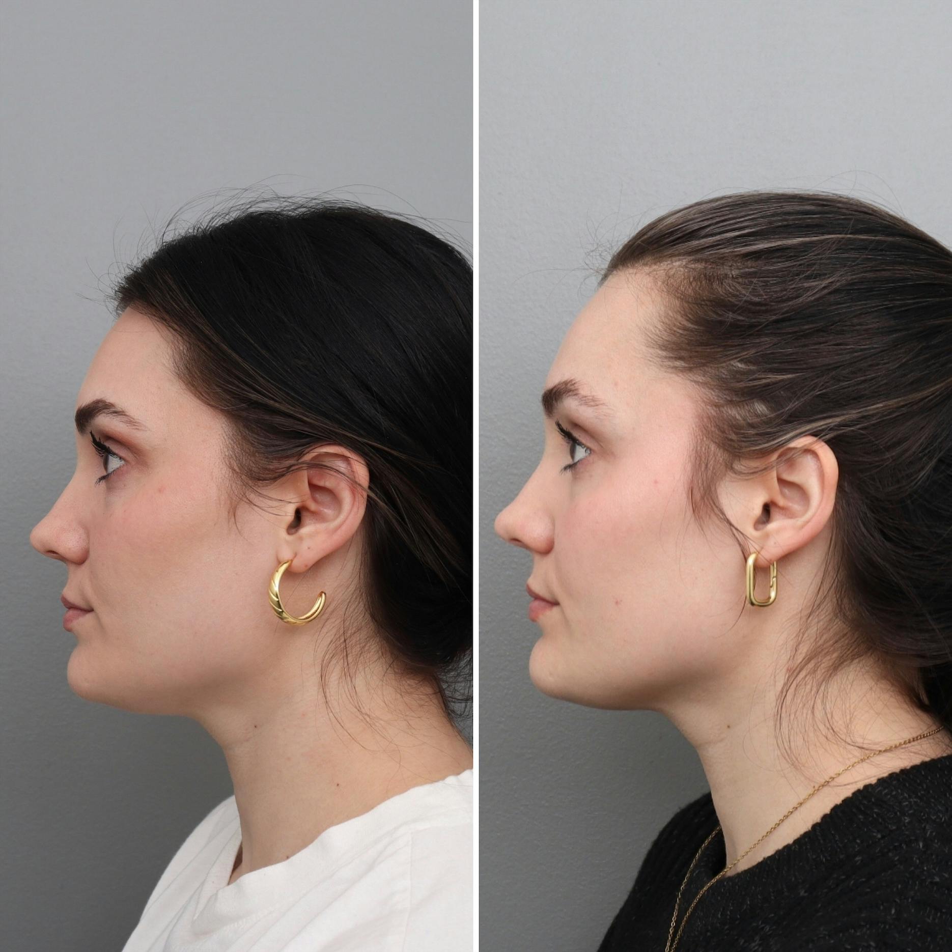 Jawline/Chin Before & After Gallery - Patient 182101181 - Image 2