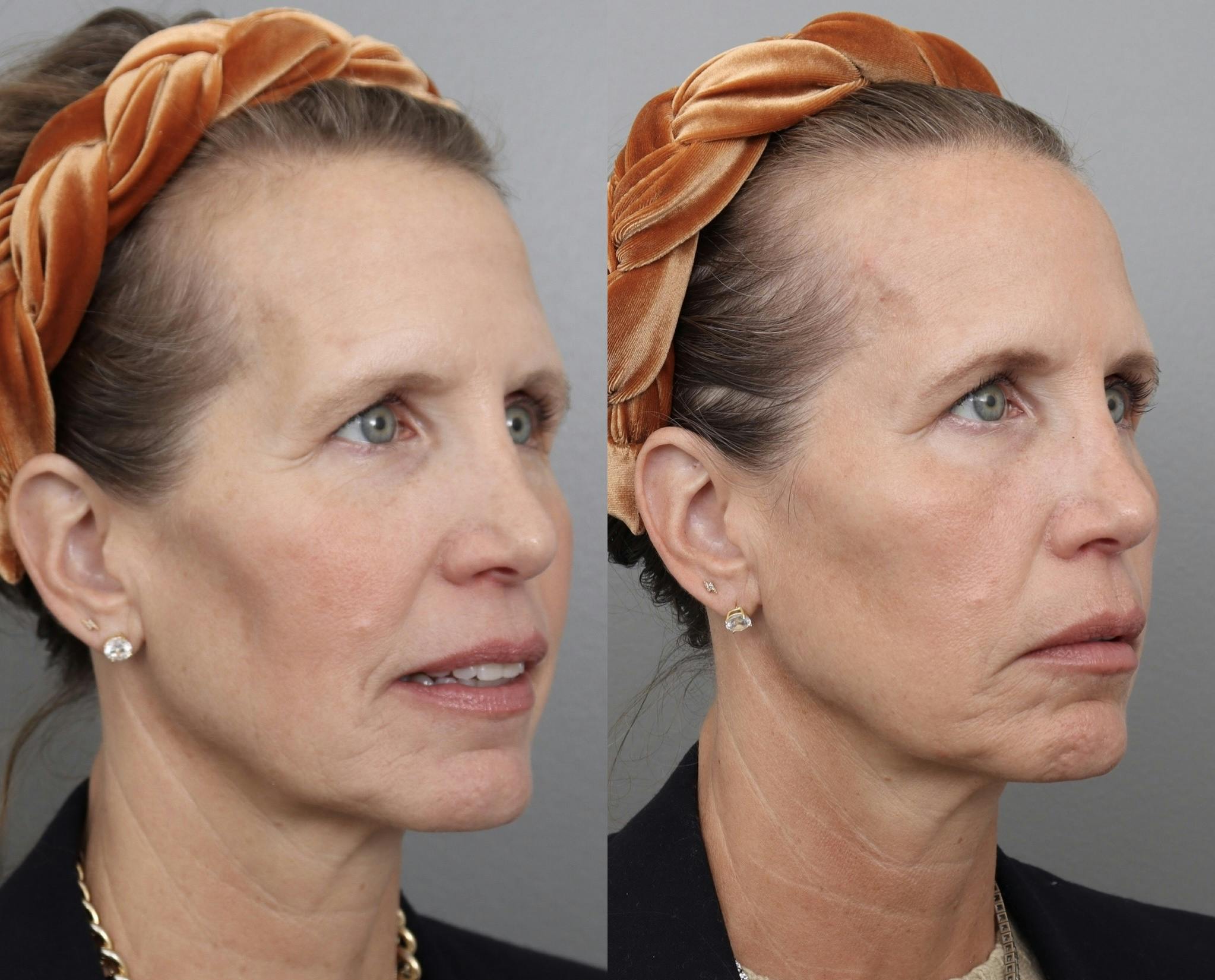 Sculptra Before & After Gallery - Patient 182101184 - Image 1