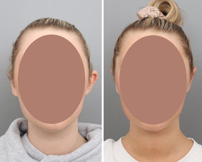 Ear Pinning (Otoplasty) Before & After Gallery - Patient 183858309 - Image 1