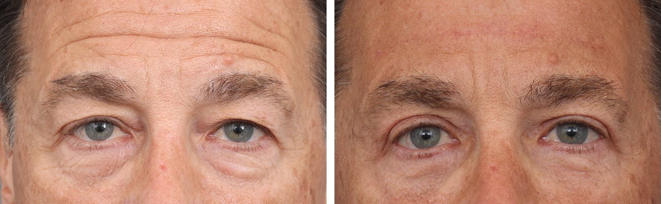Brow Lift Before & After Gallery - Patient 183858310 - Image 1