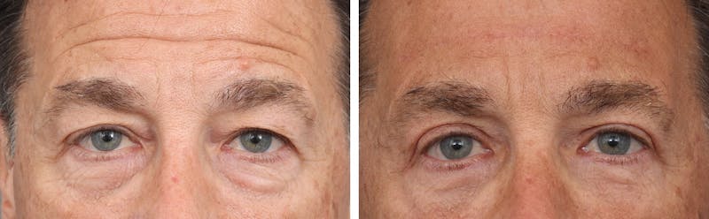 Brow Lift Before & After Gallery - Patient 183858310 - Image 1