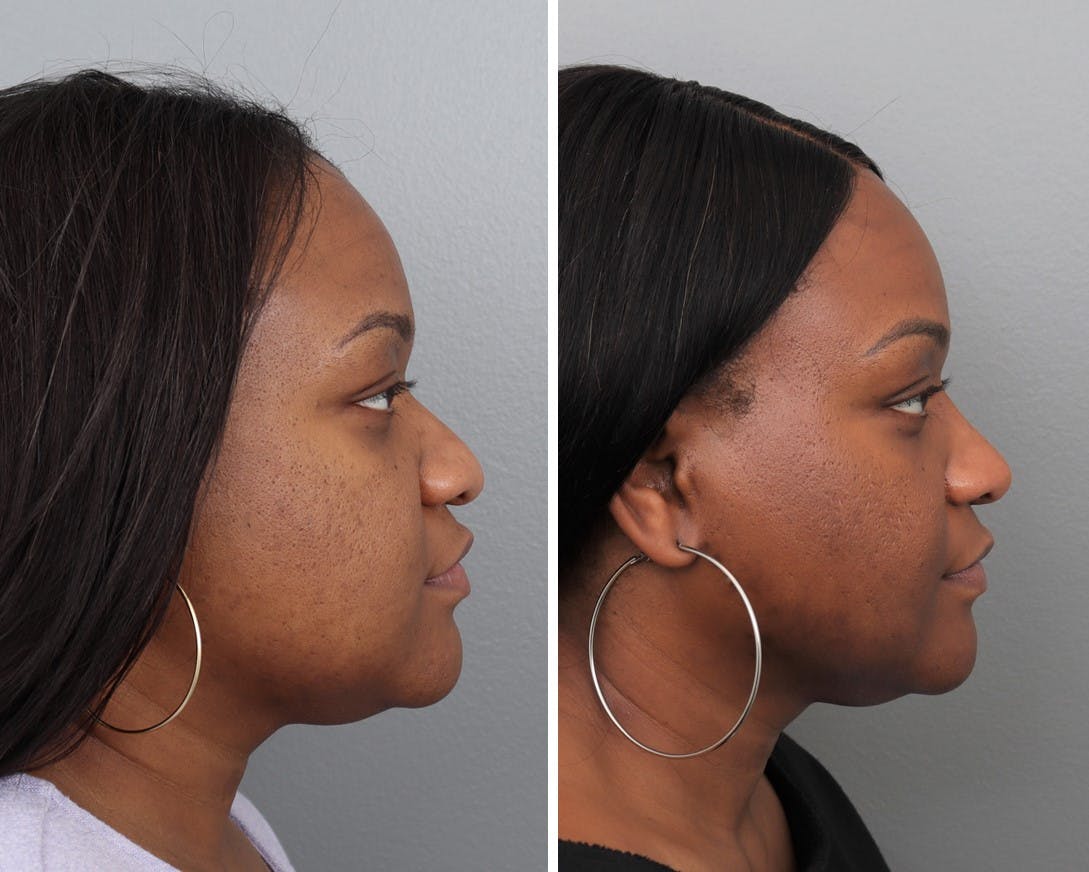 Rhinoplasty Before & After Gallery - Patient 183858325 - Image 2