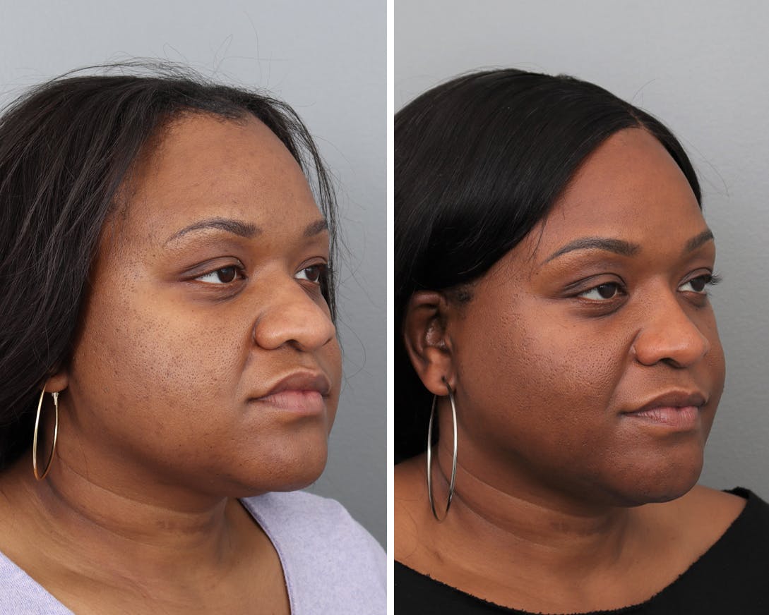 Rhinoplasty Before & After Gallery - Patient 183858325 - Image 3