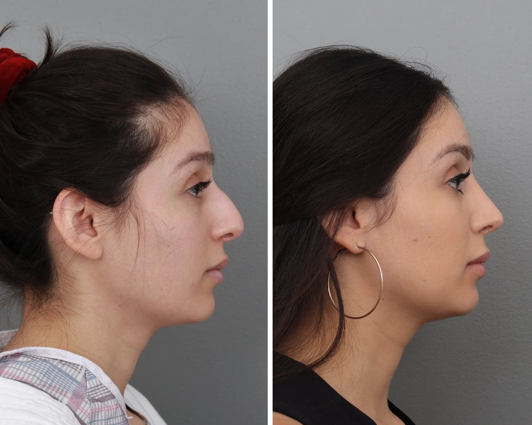 Rhinoplasty Before & After Gallery - Patient 183858326 - Image 1