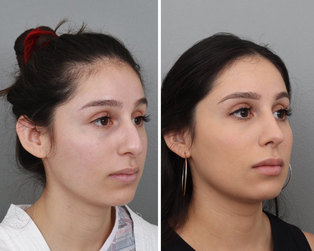 Rhinoplasty Before & After Gallery - Patient 183858326 - Image 2