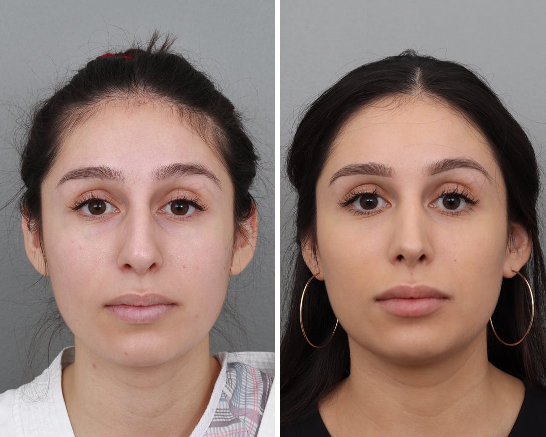 Rhinoplasty Before & After Gallery - Patient 183858326 - Image 3