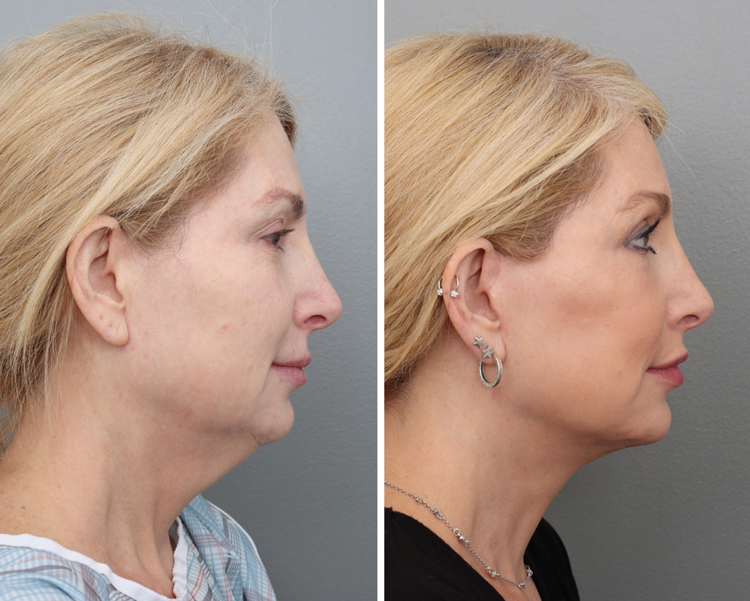 Deep Plane Facelift Before & After