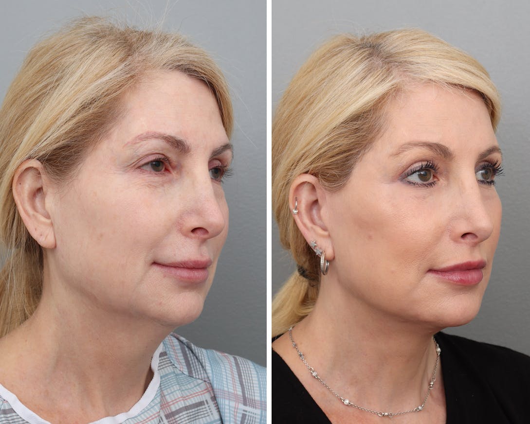 Facelift Before & After Gallery - Patient 176816879 - Image 2