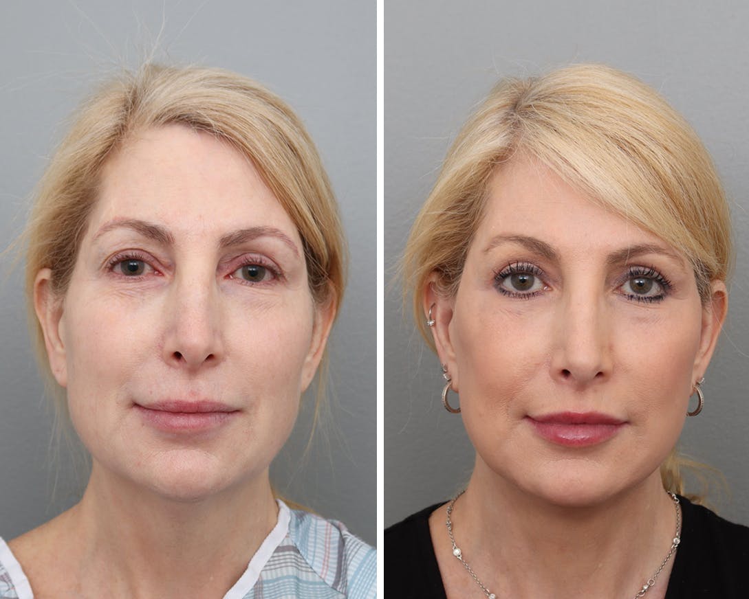 Facelift Before & After Gallery - Patient 176816879 - Image 3