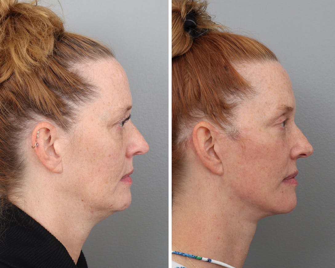 Facelift Before & After Gallery - Patient 183858329 - Image 2
