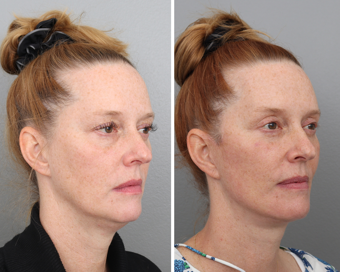 Patient 64081058 Facelift Before & After Photos Gold Coast Plastic