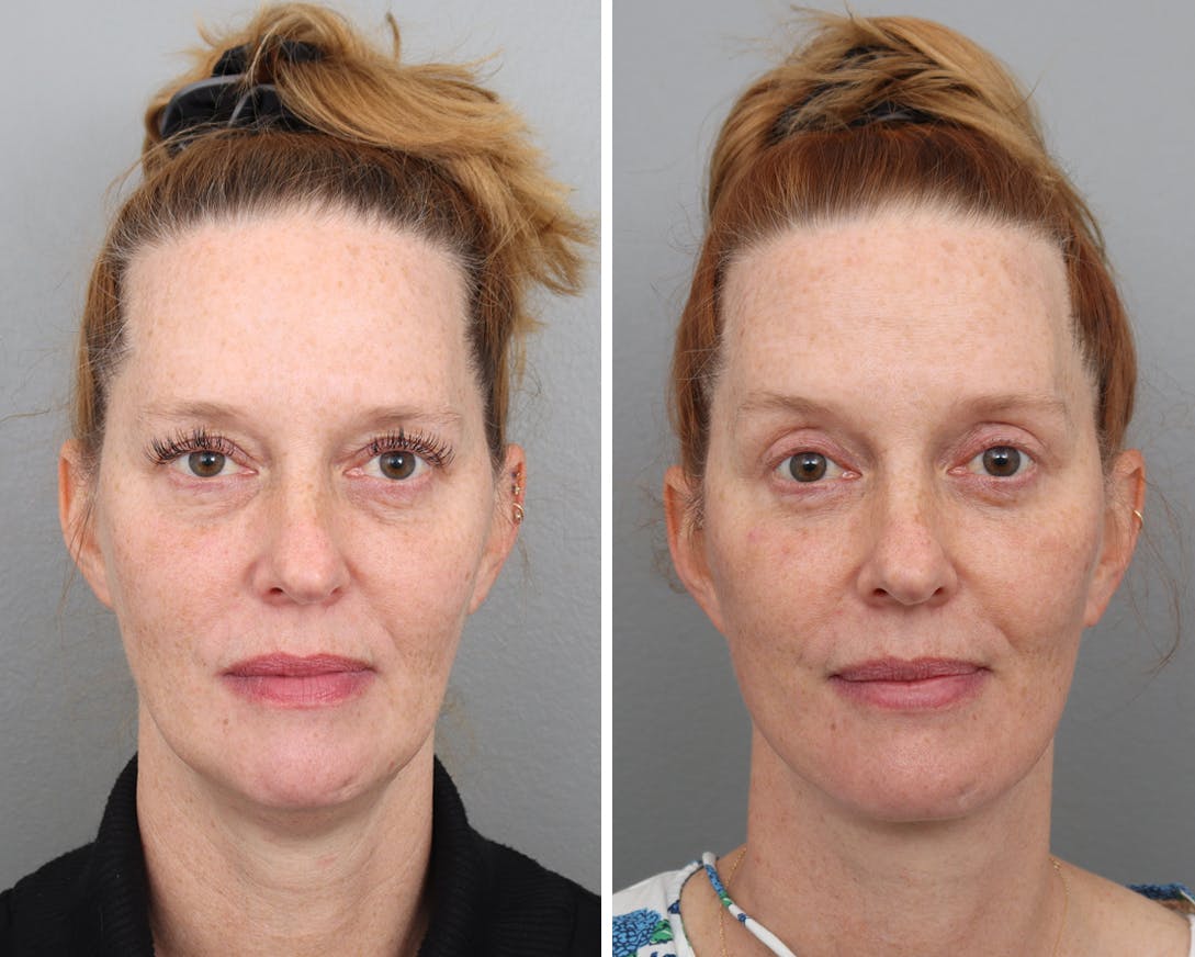 Facelift Before & After Gallery - Patient 183858329 - Image 3