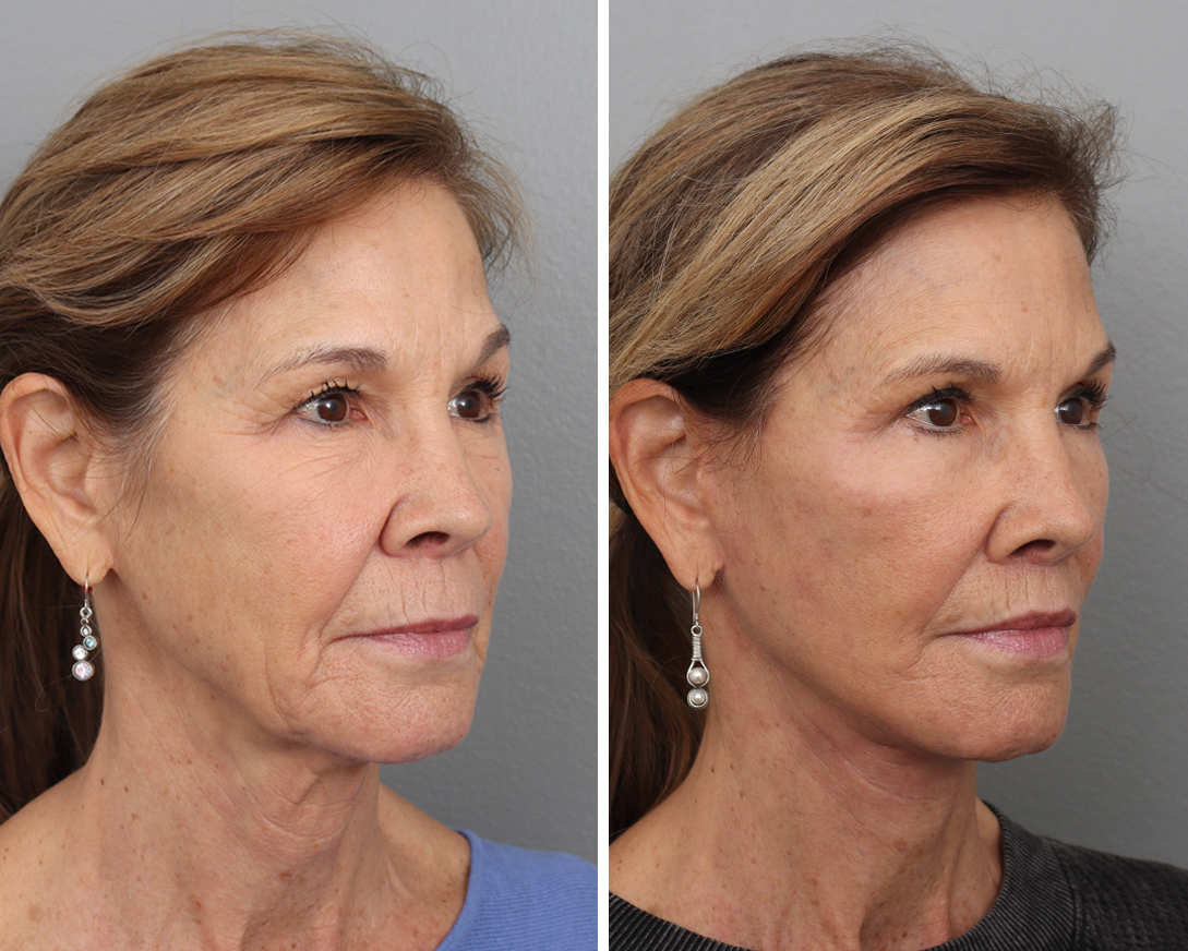 Patient 64081058 Facelift Before & After Photos Gold Coast Plastic