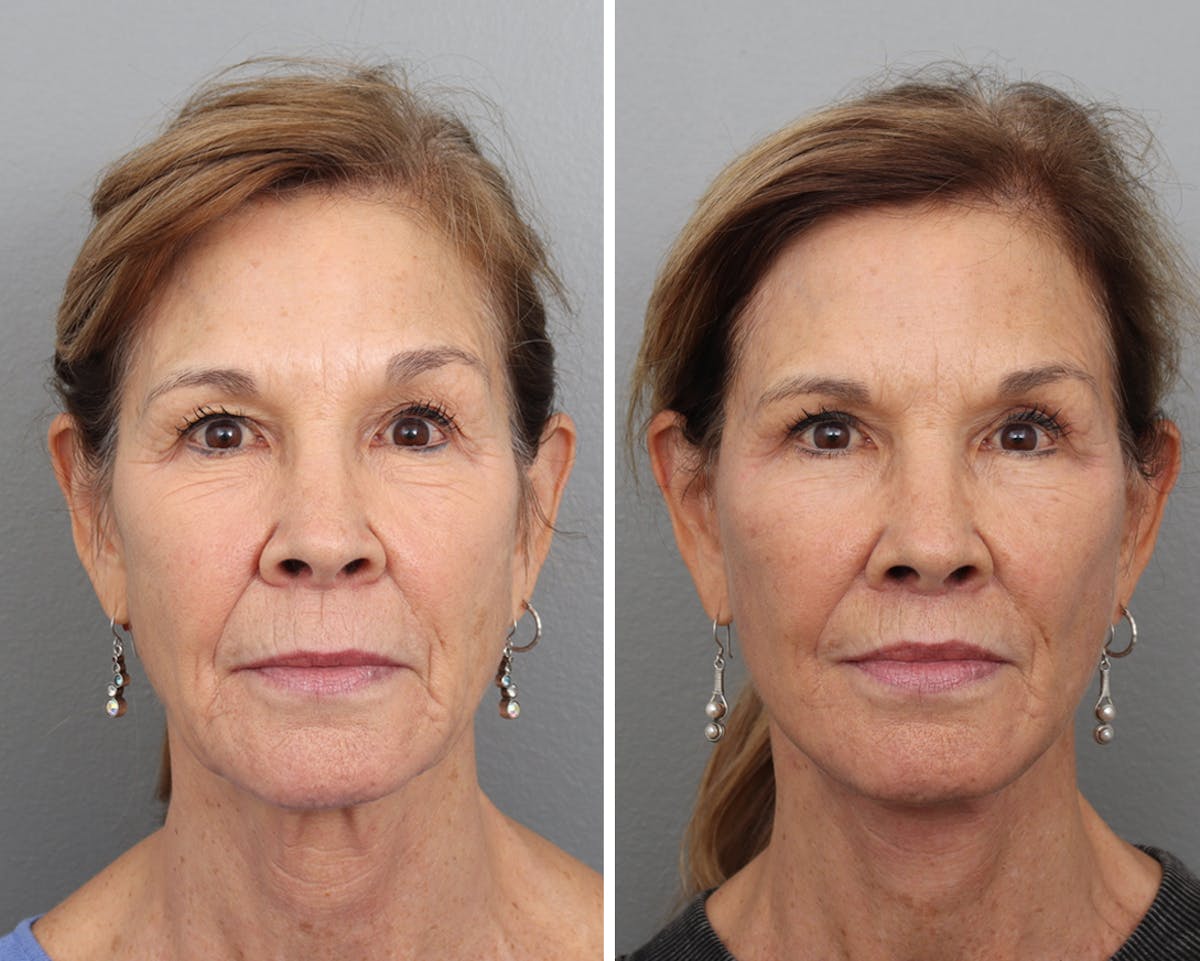 Lip Lift Before & After Gallery - Patient 257607 - Image 1