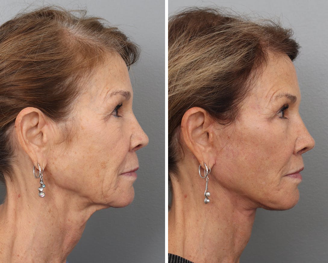 Facelift Before & After Gallery - Patient 183858328 - Image 3
