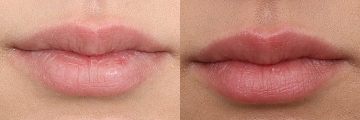 Lip Augmentation Before & After Gallery - Patient 190559849 - Image 1