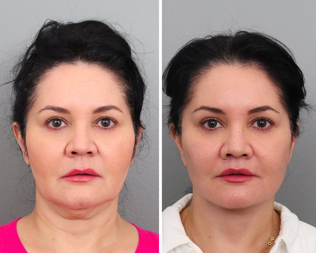 Facelift Before & After Gallery - Patient 200823728 - Image 2