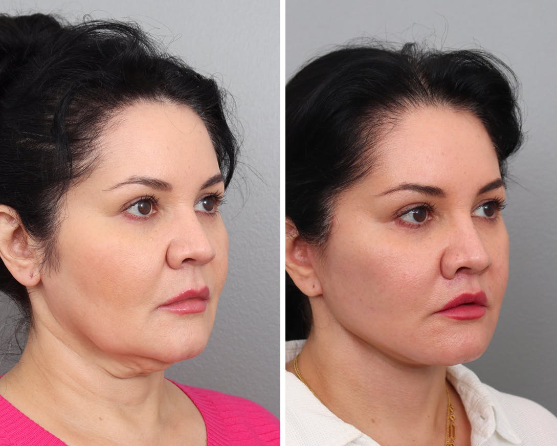 Facelift Before & After Gallery - Patient 200823728 - Image 3