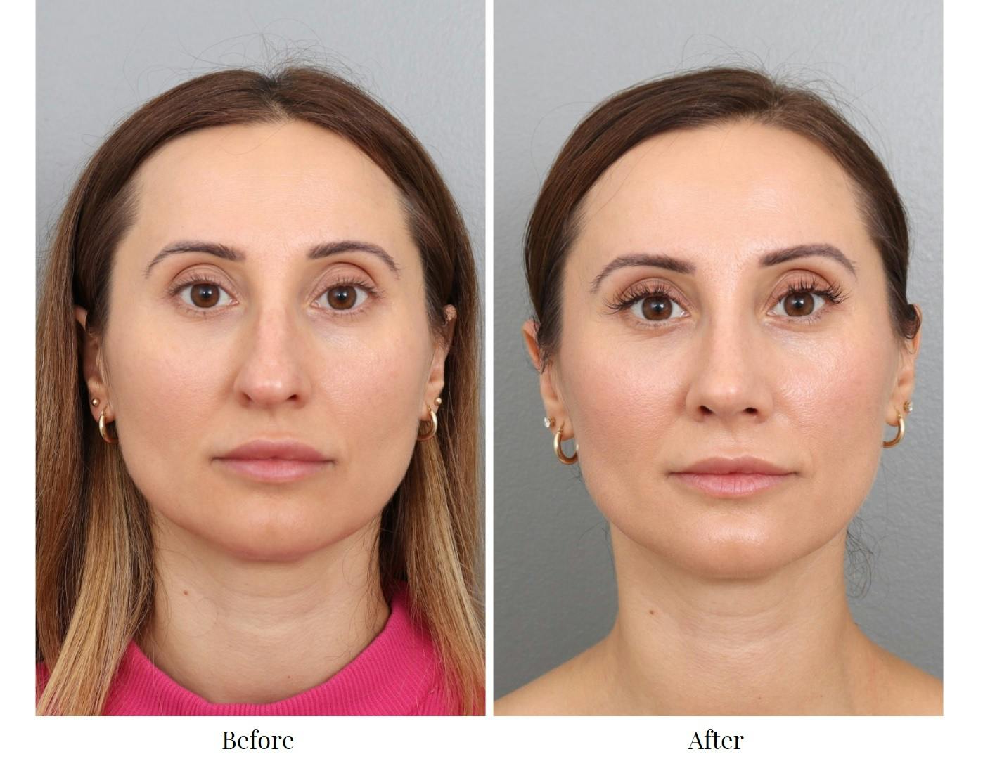 Rhinoplasty Before & After Gallery - Patient 201166899 - Image 2