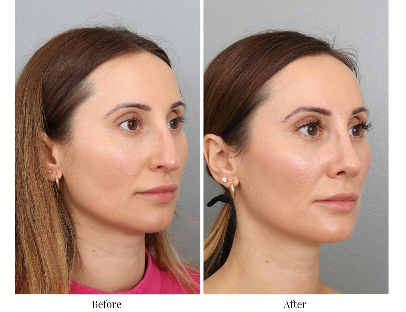 Rhinoplasty Before & After Gallery - Patient 201166899 - Image 3