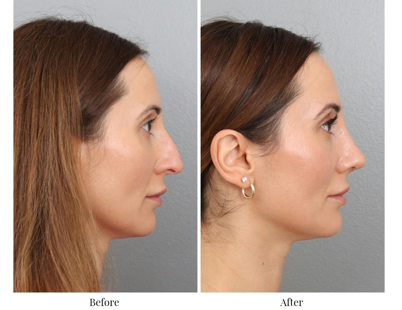Rhinoplasty Before & After Gallery - Patient 201166899 - Image 4