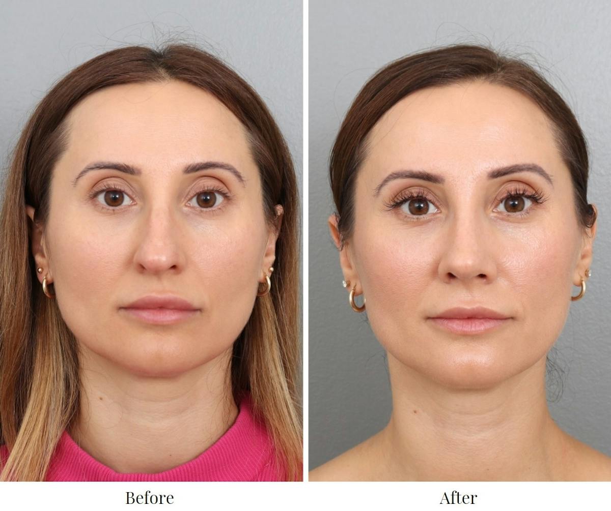 Rhinoplasty Before & After Gallery - Patient 201166899 - Image 1