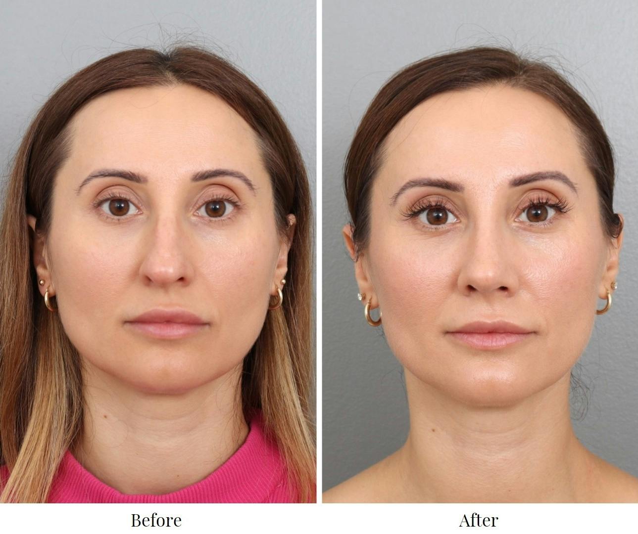 Rhinoplasty Before & After Gallery - Patient 201166899 - Image 1