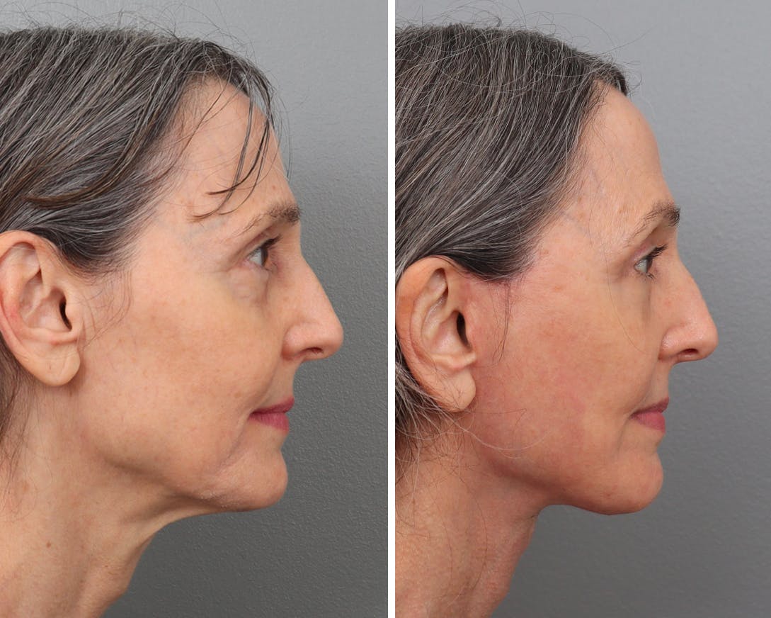 Facelift Before & After Gallery - Patient 201914763 - Image 2