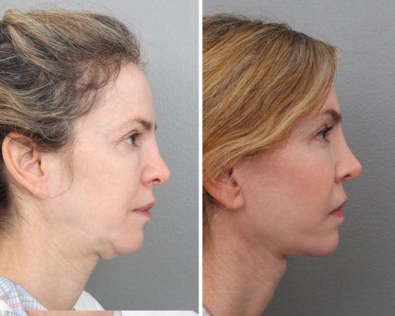 Facelift Before & After Gallery - Patient 201914764 - Image 1