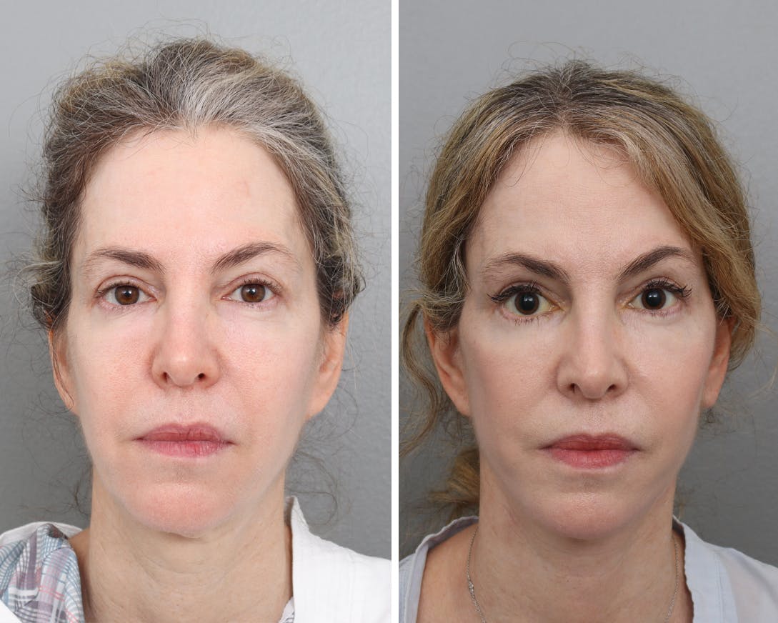 Facelift Before & After Gallery - Patient 201914764 - Image 3