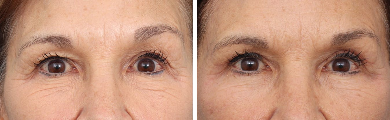 Brow Lift Before & After Gallery - Patient 205254555 - Image 1