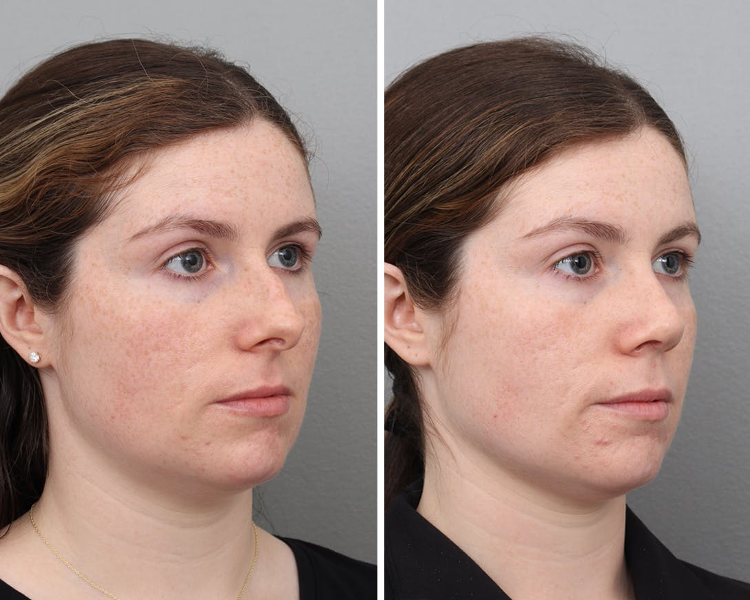 Rhinoplasty Before & After Gallery - Patient 154468 - Image 1