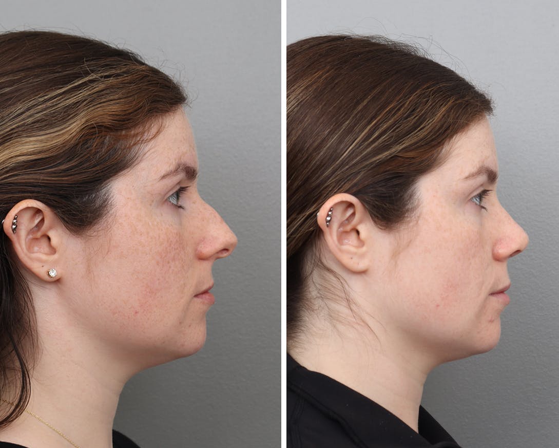 Rhinoplasty Before & After Gallery - Patient 154468 - Image 2