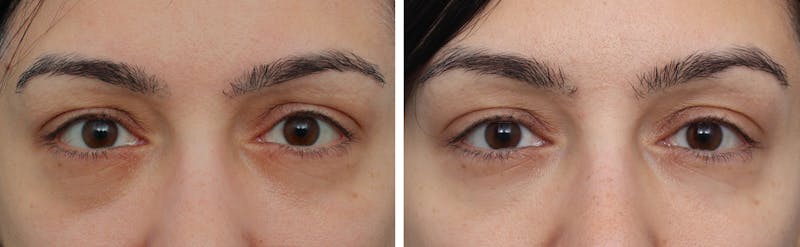 Blepharoplasty Before & After Gallery - Patient 205239 - Image 1