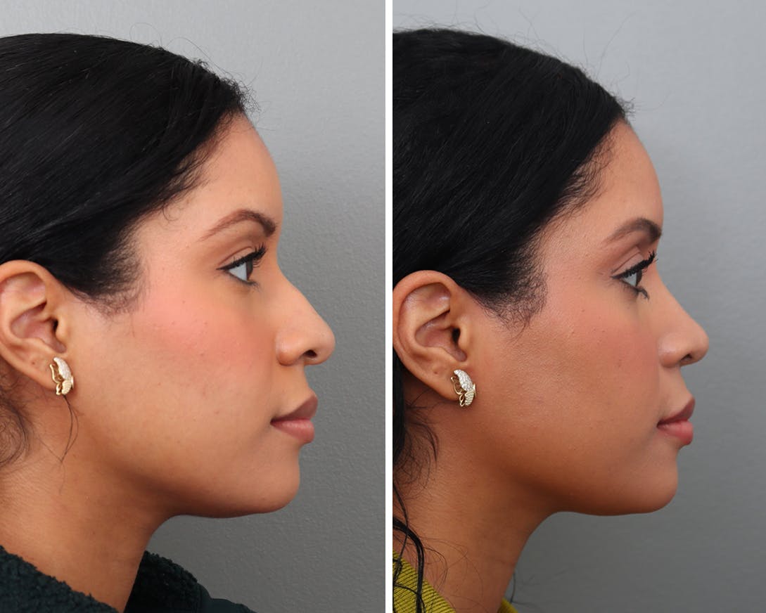 Rhinoplasty Before & After Gallery - Patient 408891 - Image 1